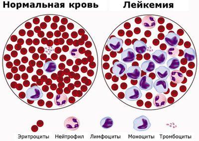 Кровь при лейкозе