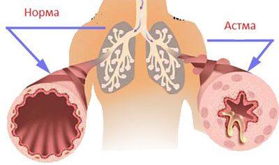 Проявление астмы