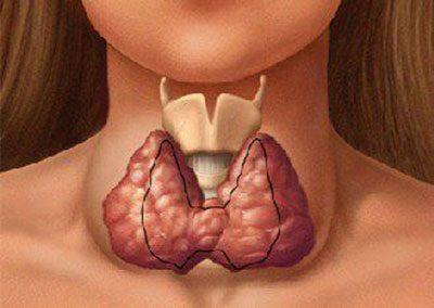 Щитовидная железа при гипертиреозе