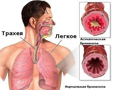 Бронхиальнаяь астма