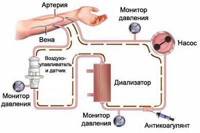 Система гемодиализа