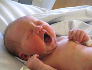 Инфекциякожных-покровов-при-токсоплазмозе-у-новорожденных-300x229.jpg