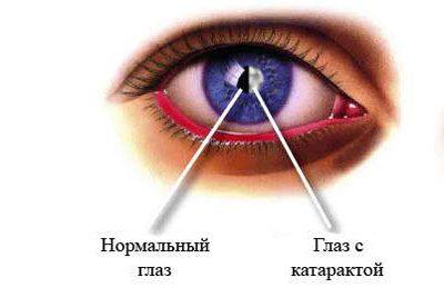 Проявление катаракты