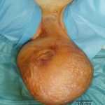 Preoperative-view-of-the-patient-with-massive-scrotal-elephantiasis-150x150.jpg