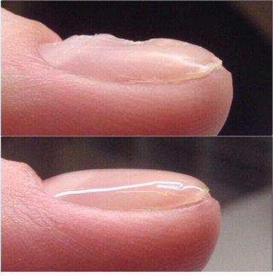 Укрепление ногтевой пластины 
