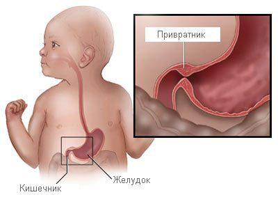 Пилоростеноз у ребенка