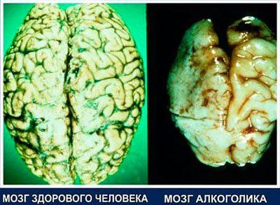 Мозг алкоголика