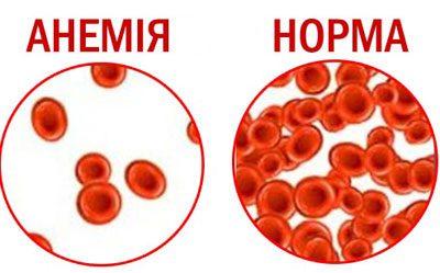 Кровь при анемии