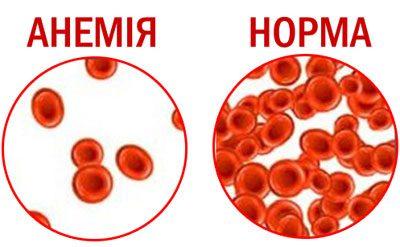 Анемия норма крови