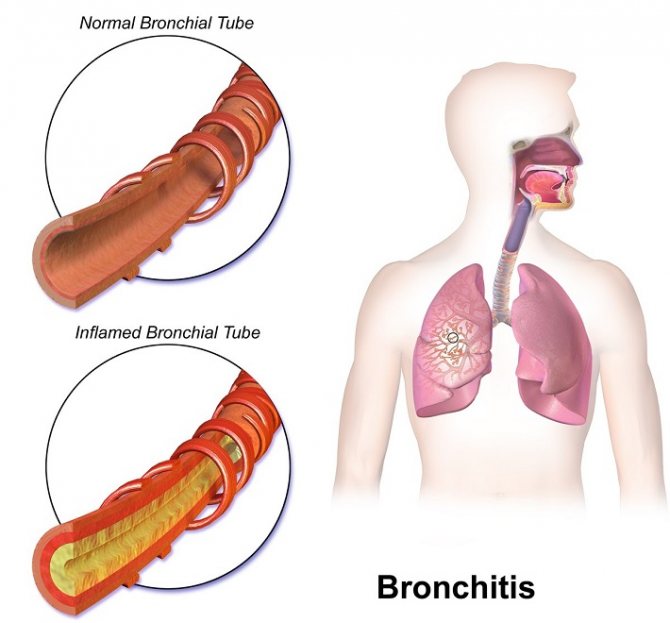 bronhit-oslozhnenie-posle-protivogelmintnoj-terapii.jpg