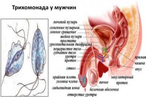 diagnostirovanie_i_lechenie_trihomoniaza_u_muzhchin_3-300x200.jpg