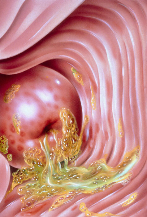 illustration-of-trichomonas-of-the-cervix-john-bavosi.jpg
