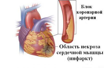Механизм развития инфаркта миокарда
