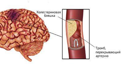 Мозг при инсульте