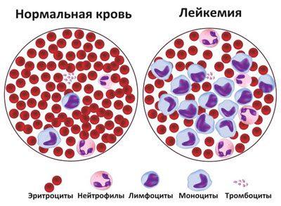 Кровь при лейкемии