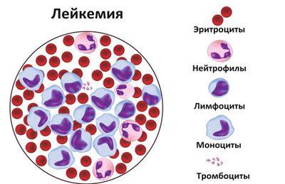 Кровь при лейкемии