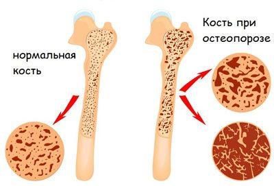 Кость при остеопорозе