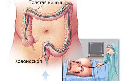 Эндоскопическое исследование прямой кишки