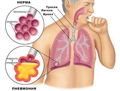 Проявление пневмонии