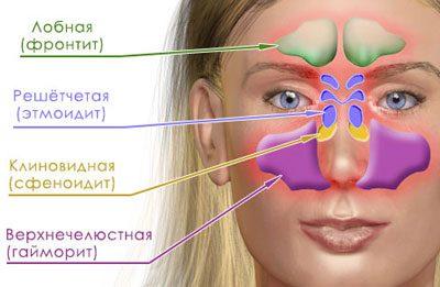 Виды синуситов