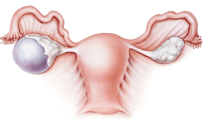 Пароовариальные кисты яичника: все, что нужно знать пациентке
