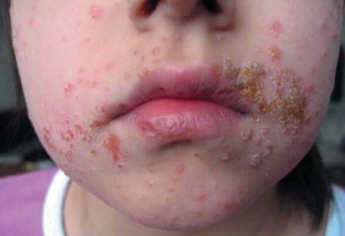 stafilokokkovaya-infekciya-na-kozhe-lica.jpg