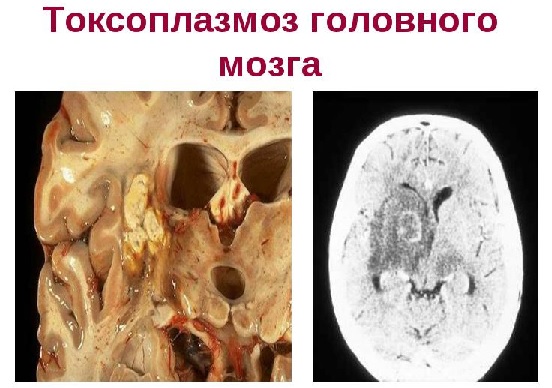 toksoplazmoz-golovnogo-mozga1.jpg