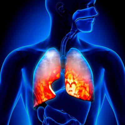 Воспаление лёгких